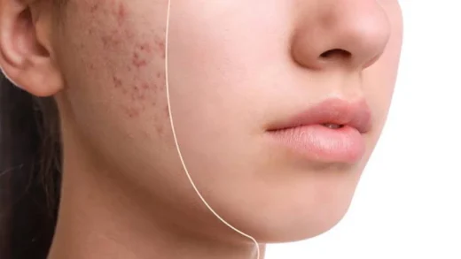 Pilih Skincare yang Tepat untuk Kulit Berjerawat